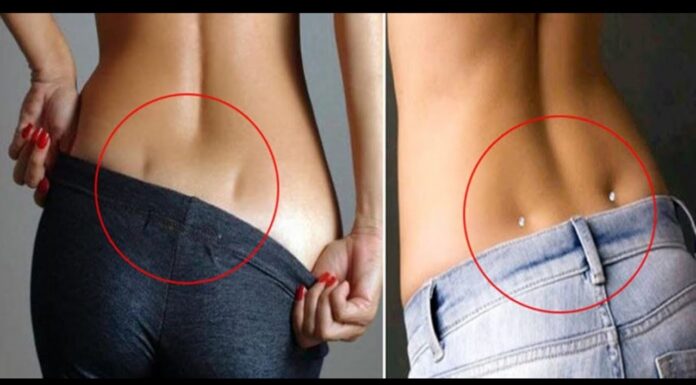 Zoom sur la fossette sacro coccygienne et comment le diagnostiquer ? Fossette sacro coccygienne