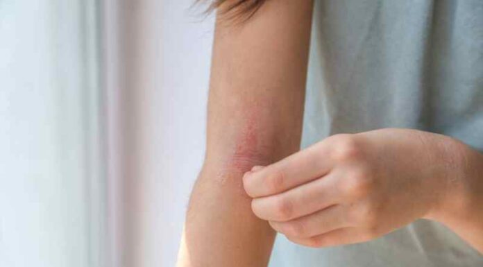 Les troubles cutanés les plus courants et leurs traitements Les troubles cutanés les plus courants et leurs traitements