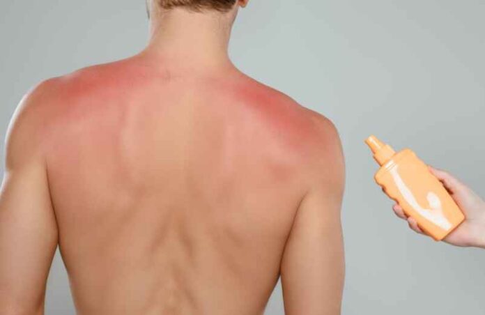 Coup de soleil attrapé : l’astuce miracle pour apaiser la peau rapidement