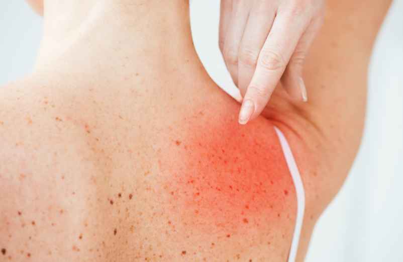 Coup de soleil attrapé