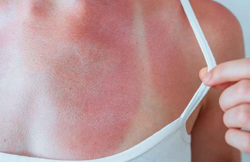 L’astuce miracle pour apaiser la peau rapidement